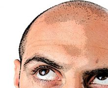 Fda, approvato primo farmaco che fa ricrescere i capelli ai colpiti da alopecia