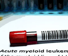 Leucemia mieloide acuta, via libera dell’Aifa a rimborsabilità farmaco innovativo
