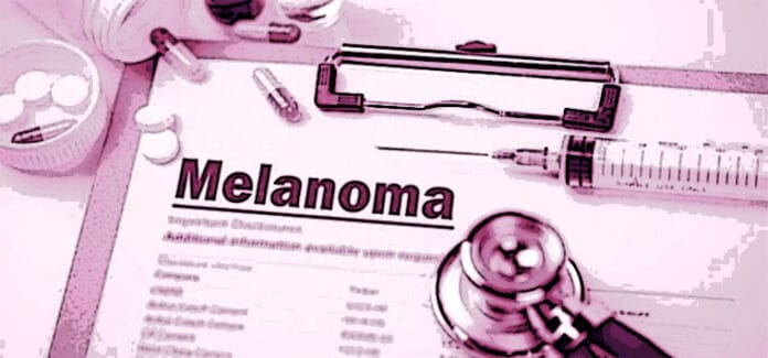 melanoma
