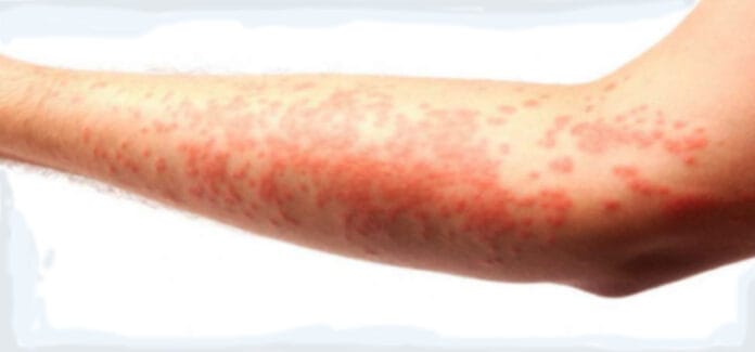 orticaria 1